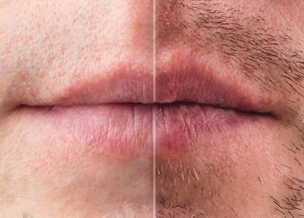 Beard Hair Transplant Results