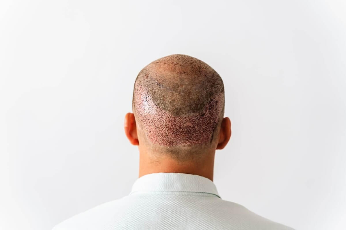 Hair Transplant Donor Area: Importance, Healing, and Long-Term Care Explained