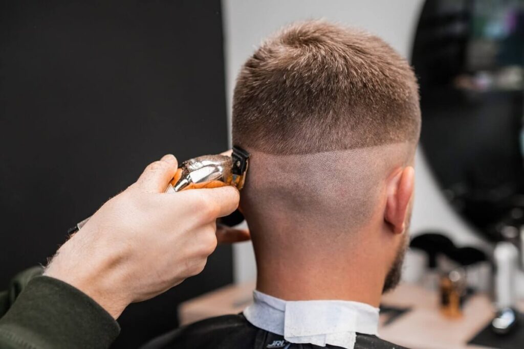 Donor Area without Scars - After Hair Transplant